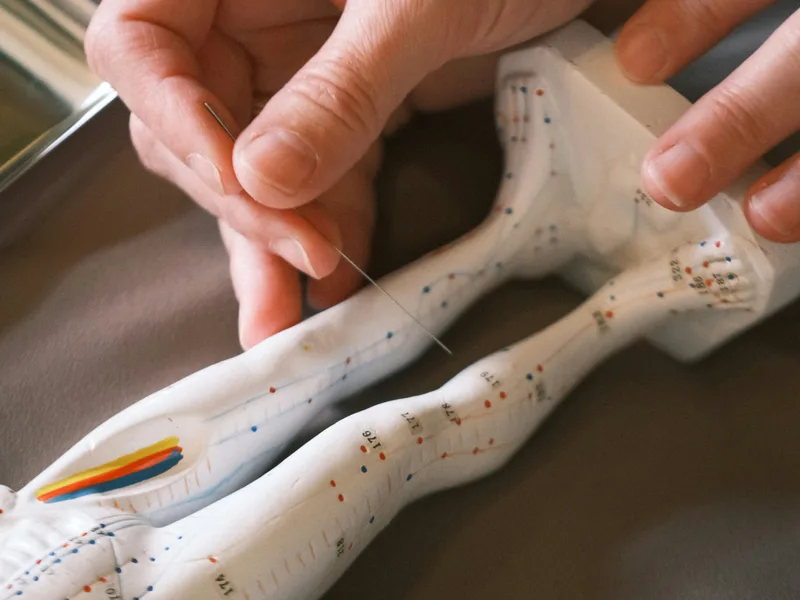 Acupuncture at Nokomis Chiropractic and Wellness in Minneapolis