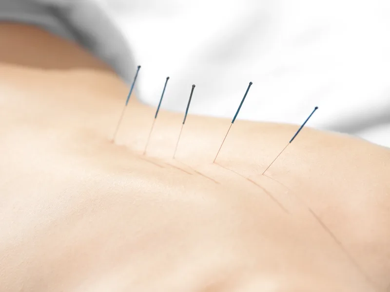 Acupuncture at Nokomis Chiropractic and Wellness in Minneapolis