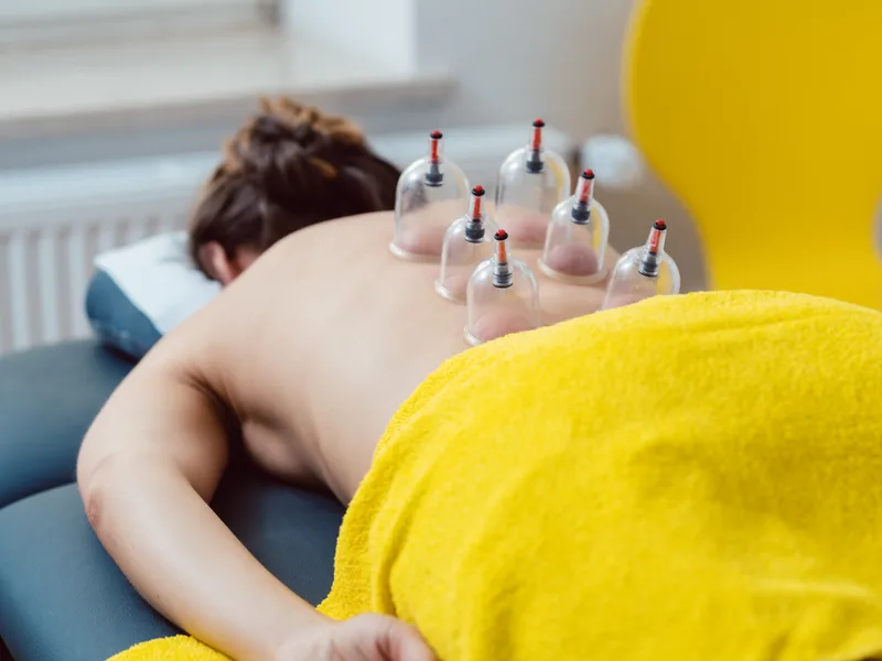 Cupping Therapy at Nokomis Chiropractic and Wellness in Minneapolis