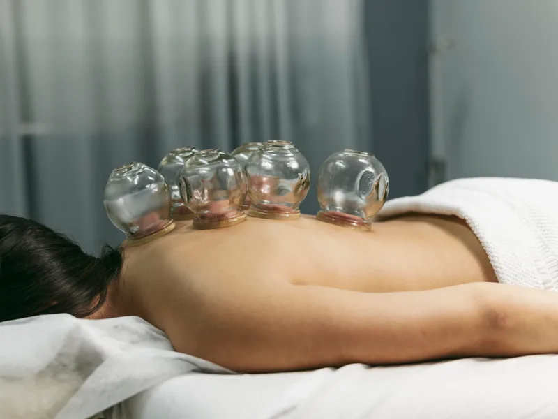 Cupping Therapy at Nokomis Chiropractic and Wellness in Minneapolis