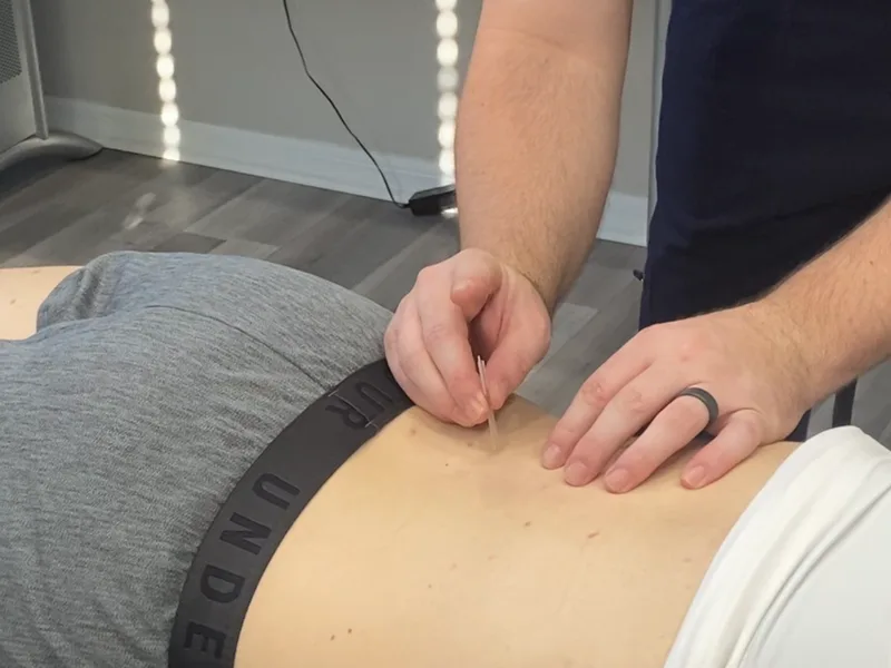 How Dry Needling works at Nokomis Chiropractic and Wellness