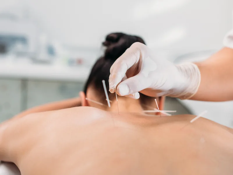 Dry Needling at Nokomis Chiropractic and Wellness in Minneapolis