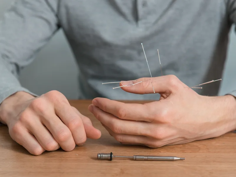 Dry Needling at Nokomis Chiropractic and Wellness in Minneapolis